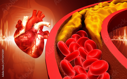 Blood vessel blockage, Heart attack, coronary artery disease
 and atherosclerosis condition. 3d illustration