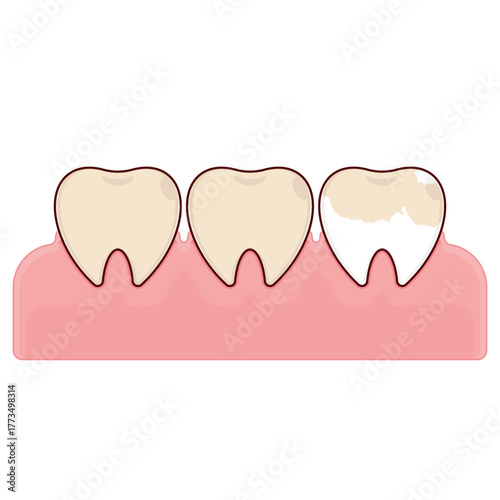 Tooth discoloration from coffee cartoon cute