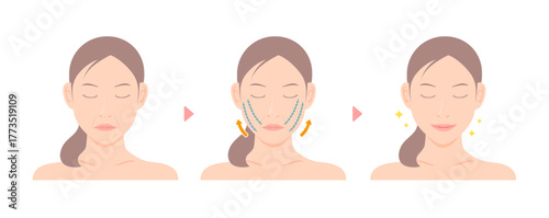 Vector illustration of how a thread lift works