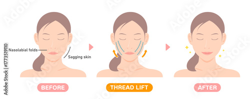 Vector illustration of how a thread lift works