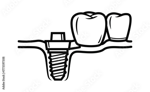 Dental implant screw placed in bone below gum line with adjacent teeth