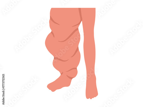Leg a Person Elephantiasis Disease Illustration
