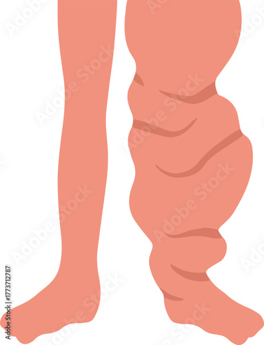 Leg a Person Affected Disease Illustration
