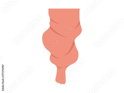 Elephantiasis Disease Illustration
