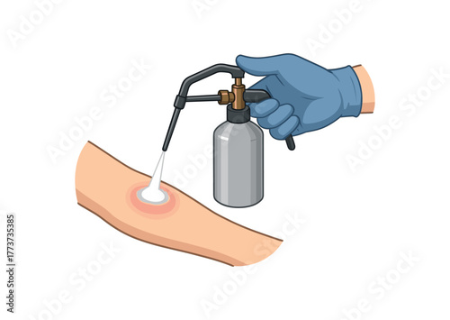 liquid nitrogen application to skin localized treatment and controlled freezing flat vector illustration style isolated on white background