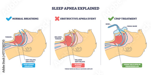 Normal breathing overview shows airflow, tongue and soft palate shape open vs blocked airway. CPAP holds airway open. Key objects, airway, tongue, nasal mask. Outline diagram