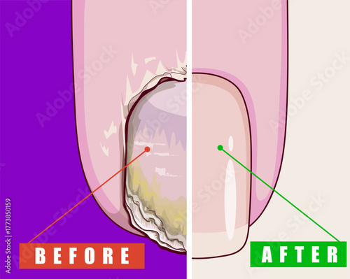 Nail plate disease. Healing of the nail plate. Before after. Tender manicure. Healthcare illustration. Vector illustration. 