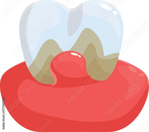 Periodontitis causing swollen gums and bleeding, damaging a tooth with caries and dental plaque