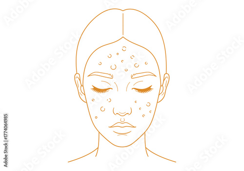 Acne Face Skin Problem Illustration.