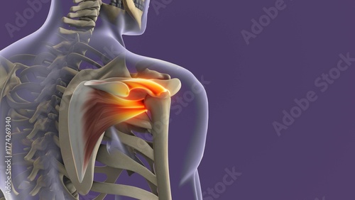 Shoulder Joint Inflammation Due to Rotator Cuff Strain