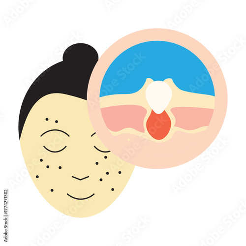 Pimple Skin Problem illustration