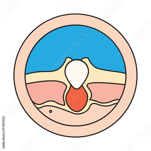 Acne Skin Cross Section