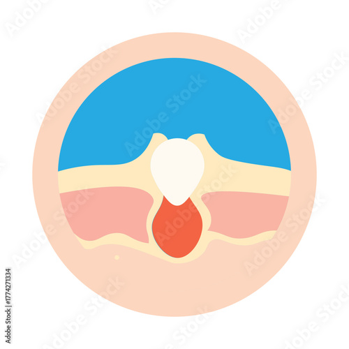 Acne Skin Cross Section