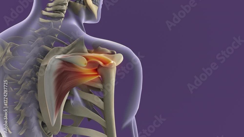 Shoulder Joint Inflammation Due to Rotator Cuff Strain