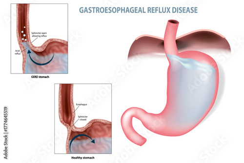 Gastroesophageal Reflux Disease Diagram, GERD and Healthy Stomach Comparison. Acid Reflux Anatomy Illustration Showing Esophagus and Stomach Structure. Open and Closed Sphincter