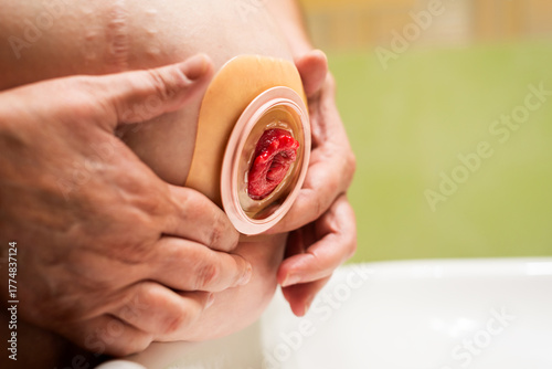 Female hands attaching ostomy barrier on a stoma at home, close-up view