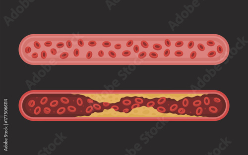 Illustration of a healthy blood vessel and one with atherosclerosis a vector graphic showing the difference for medical and educational purposes