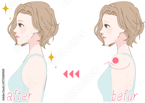 巻き肩を整える女性の横顔ビフォーアフター