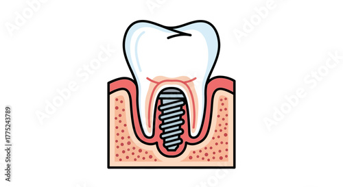 Dental implant cross-section diagram
