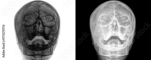 Fotografi Human Skull Pns Posteroanterior View Radiograph Highlighting Frontal Sinuses and