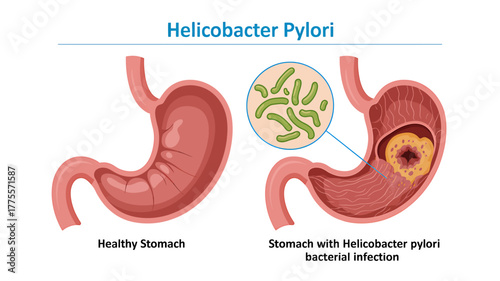 Understanding Helicobacter Pylori Human Stomach Anatomy and Bacterial Infection Visualization Comparing Healthy and Infected Digestive Systems