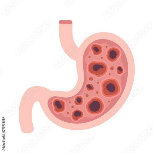 Cancer Cell Inside Stomach