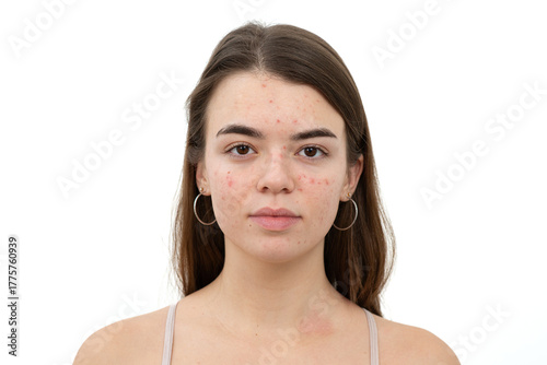 Portrait of young woman with acne on her face. Acne, skin care concept. Real photo.