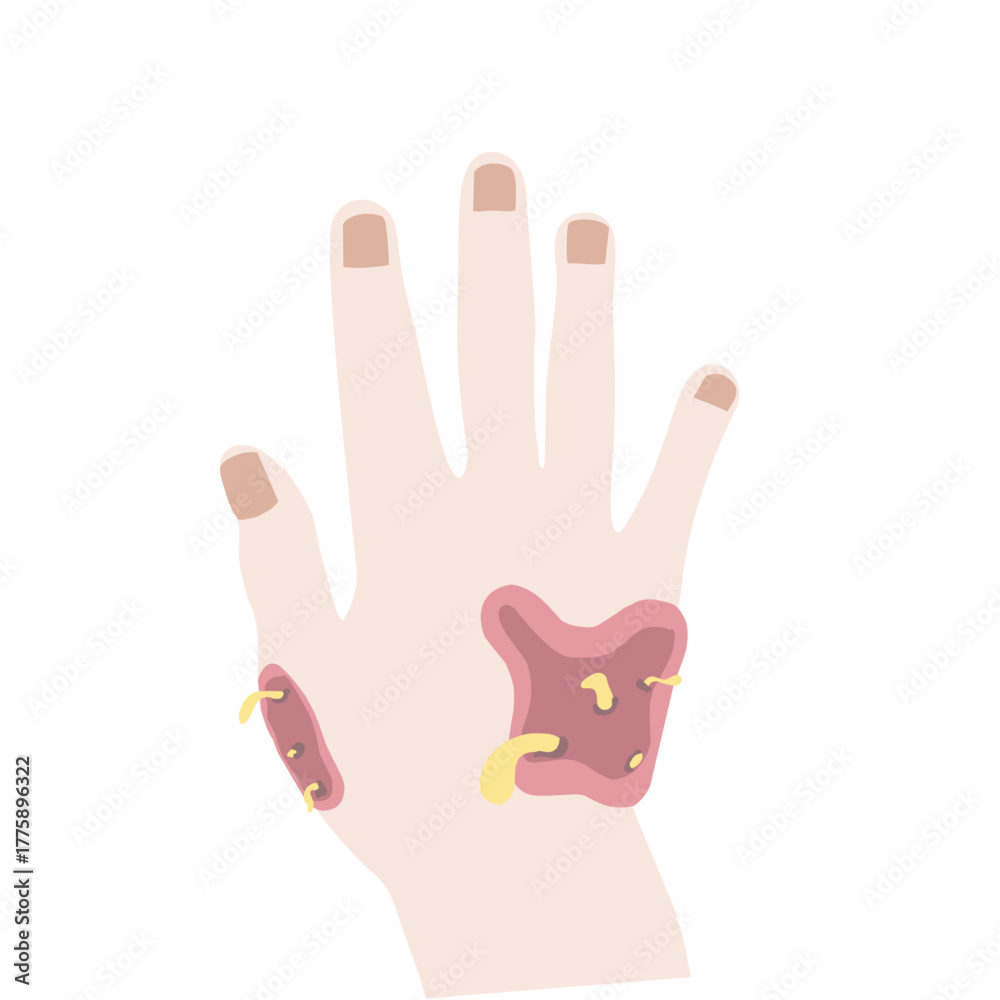 Obraz premium Infected or Allergic Hand Skin Condition Vector