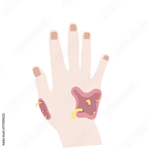 Infected or Allergic Hand Skin Condition Vector