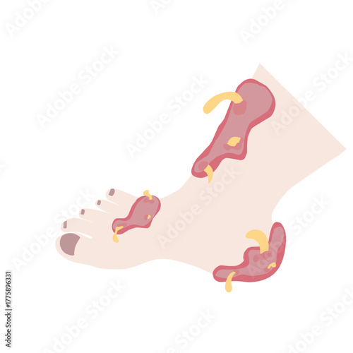 Vector Illustration of Infected Human Foot