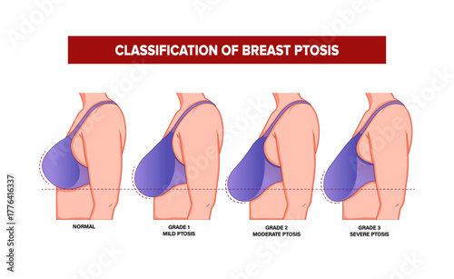 Sag Ptosis Correction Rejuvenate Breast Surgery Vector Illustration
