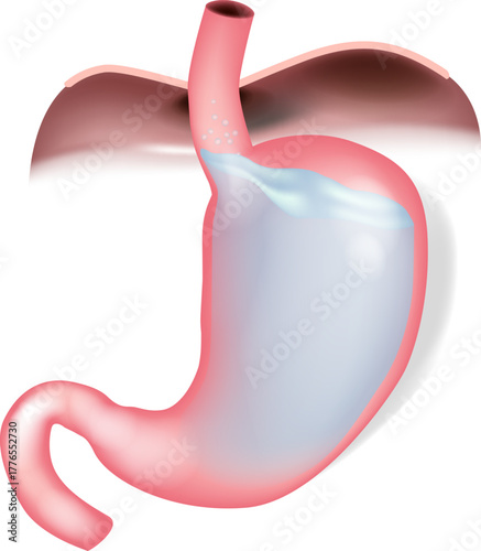 Gastroesophageal reflux disease illustration, acid reflux in stomach and esophagus. Acid reflux anatomy showing stomach contents regurgitation