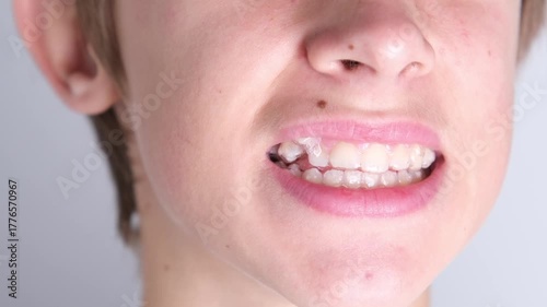 A teenage patient's teeth are shown with clear aligners. Clear aligner for teeth straightening.