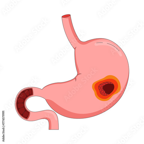 Human stomach with peptic ulcer 2D vector illustration. Anatomical organ inflammation. Digestive disease. Gastrointestinal tract wound flat object isolated on white background. Colorful cartoon image