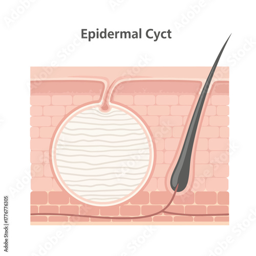Detailed cross section of human skin revealing an epidermal cyst formation near a hair follicle, illustrating dermatological conditions and medical research.