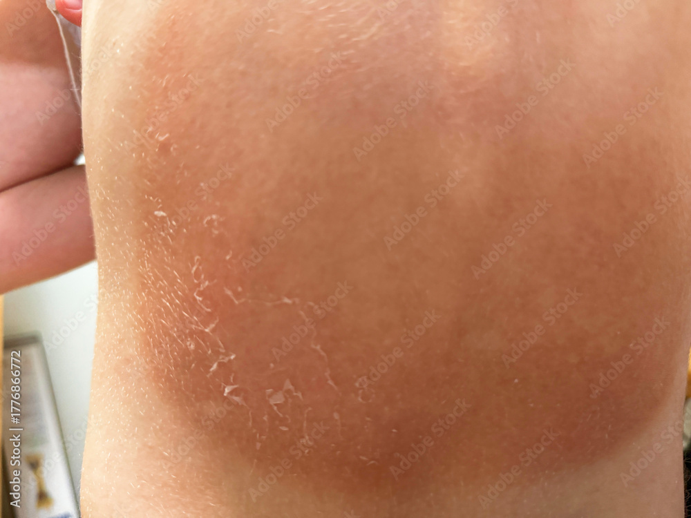 Fototapeta premium Peeling back sunburned skin on child shoulder after strong sun