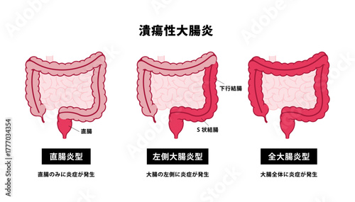 潰瘍性大腸炎の種類　ベクターイラストセット