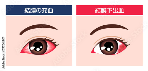 結膜下出血と結膜の充血 症状比較イラスト