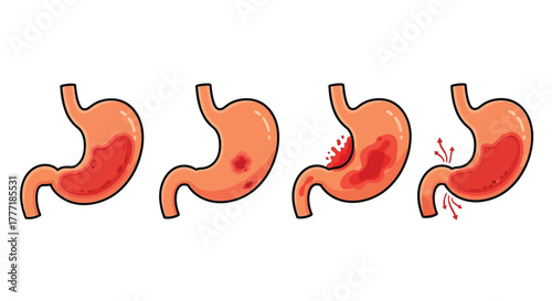 Stomach disease progression illustration showing ulcer and inflammation isolated on white background