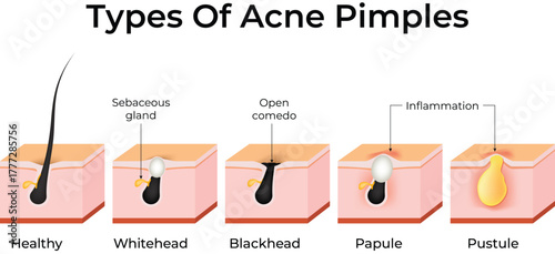 Types of Acne Pimples Explained