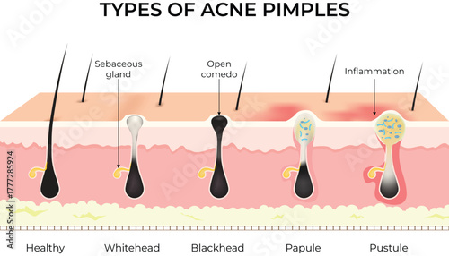 Types of Acne Pimples Skin Cross Section Diagram