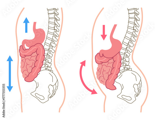 内臓下垂　内臓の位置が下がっている状態
