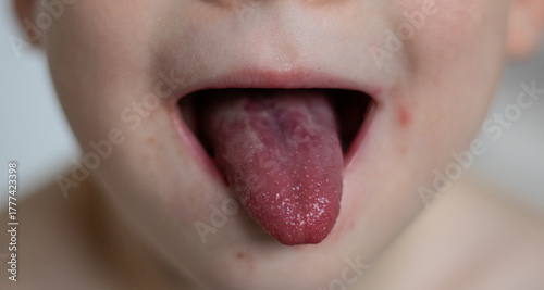 Close up of a red tongue of scarlet fever disease of a small child