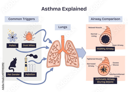 Asthma explained in a brief sketch, lungs, common triggers, and airway comparison show how pollen, dust mites, and pollution tighten airways and add mucus during attacks. Doodle style diagram