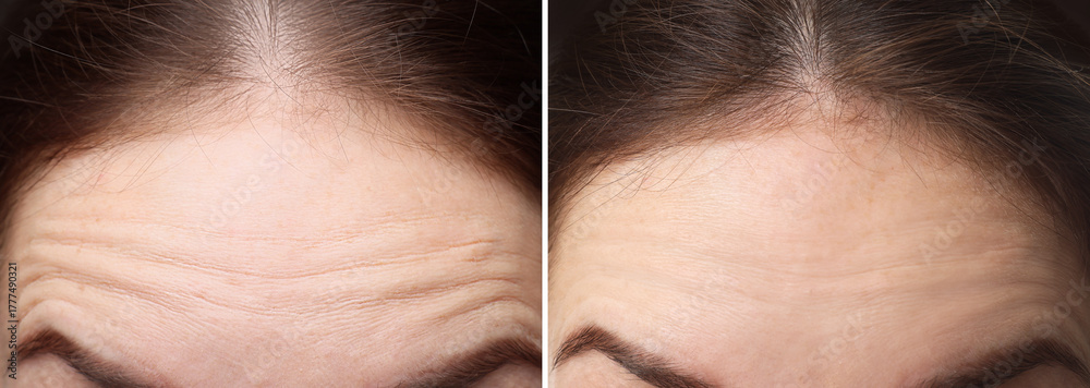 Naklejka premium Woman before and after anti-aging treatment, closeup. Collage showing skin rejuvenation