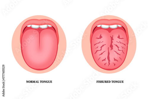 Fissured Tongue and Inflamed Mouth with Ulcers and Swelling – Oral Health Concept