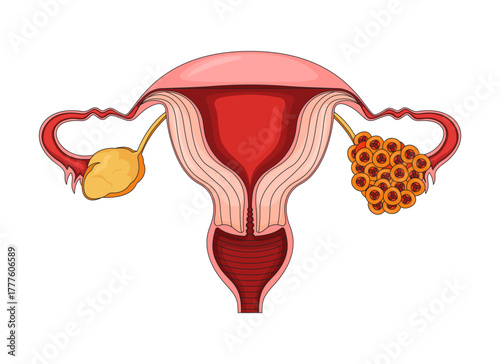 Late-stage ovarian cancer in female reproductive system 2D vector illustration. Oncology. Gynecological disease. Tumor clusters of ovary flat object isolated on white. Colorful cartoon image