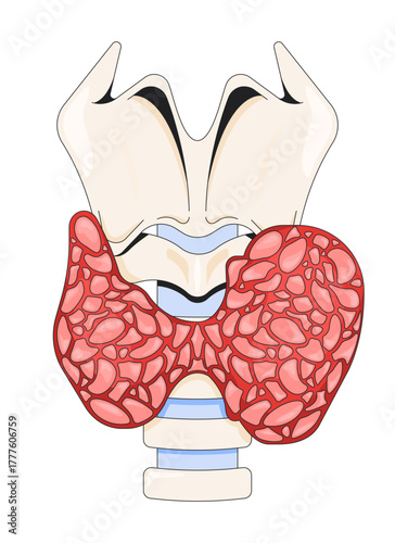Enlarged thyroid gland affected by hyperthyroidism 2D vector illustration. Hormone imbalance. Overactive disorder in neck anatomy flat object isolated on white background. Colorful cartoon image