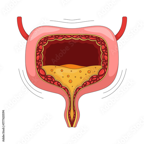 Overactive human bladder with urgency symptom 2D vector illustration. Urinary incontinence, spasms. Trembling walls and urine buildup flat object isolated on white background. Colorful cartoon image