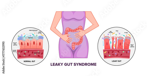 Leaky Gut Syndrome and Intestinal Bacterial Overgrowth – Digestive System Inflammation Concept